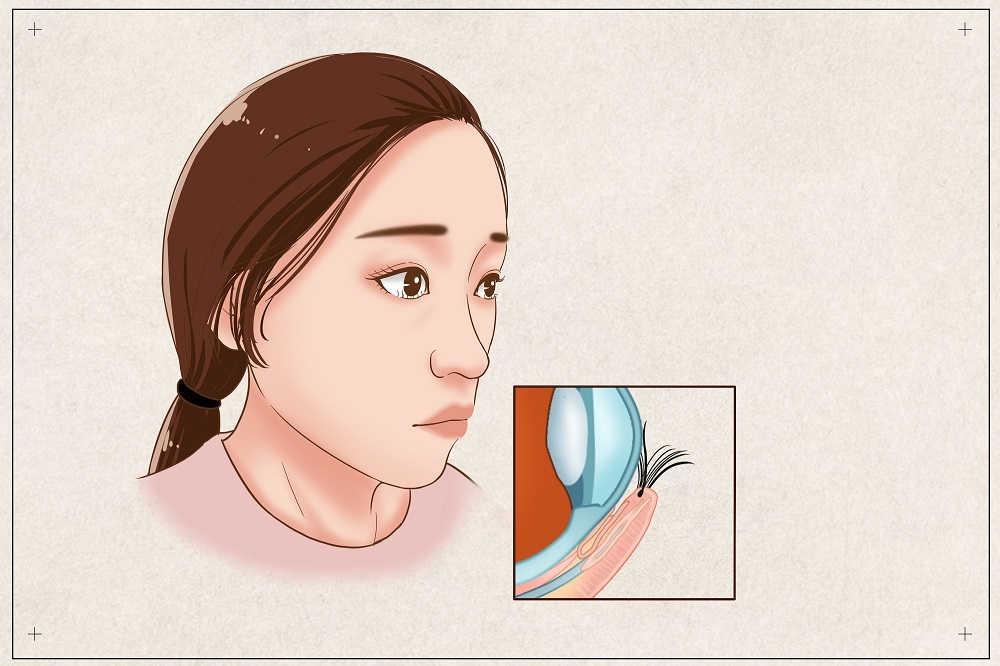 倒睫會自己好嗎？