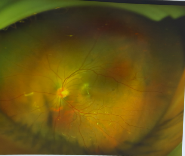 視網(wǎng)膜脫離